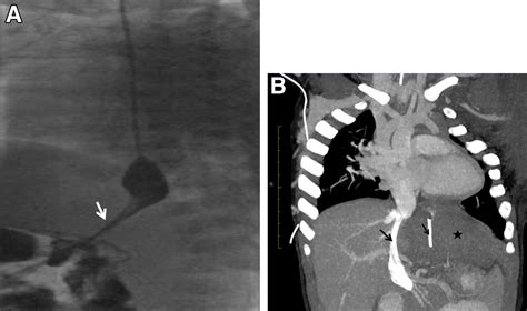 A Rare Cause of Esophageal Stenosis in an Infant - Gastroenterology