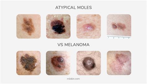 Atypical Moles Guide | Definitions, Pictures and Risks