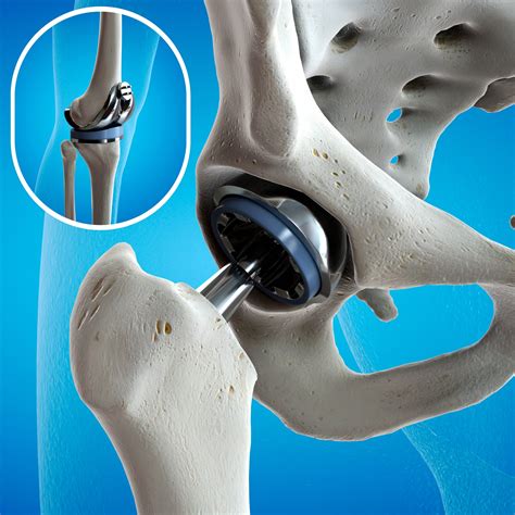 Orthopedic Implant – iltmedical