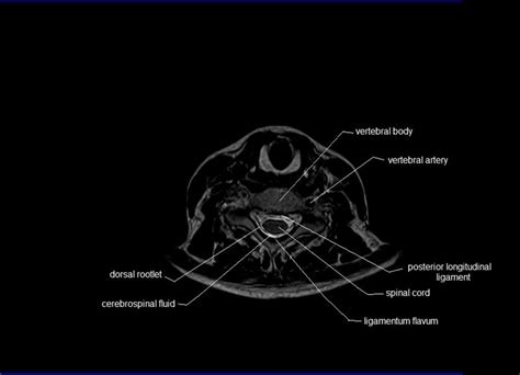 MRI spine anatomy | free MRI axial cervical spine anatomy | Mri ...