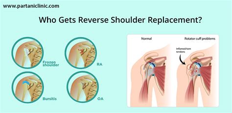 Reverse Shoulder Replacement in Jaipur by Dr. Arun | Partani Clinic