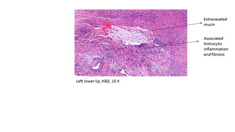 Mucocele Histology