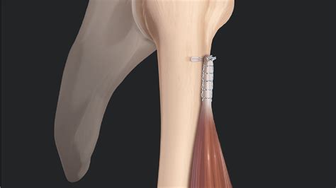 Arthrex - Biceps Tenotomy vs Tenodesis: Literature Review and Rationale ...