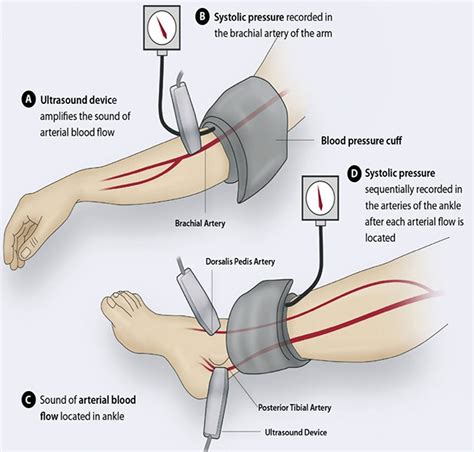 Peripheral Artery Disease - Causes, Symptoms & Treatment