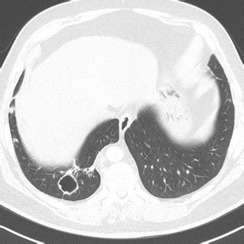 (PDF) Pulmonary Vasculitis as the First Manifestation of Rheumatoid ...