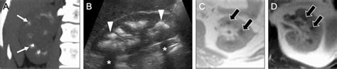 Imaging appearances of medullary nephrocalcinosis. Coronal maximum ...