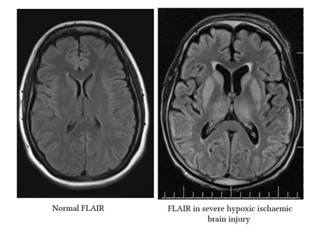 Radiological findings in hypoxic ischaemic encephalopathy | Deranged ...