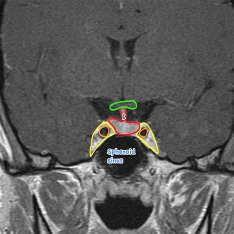 Pituitary Mri