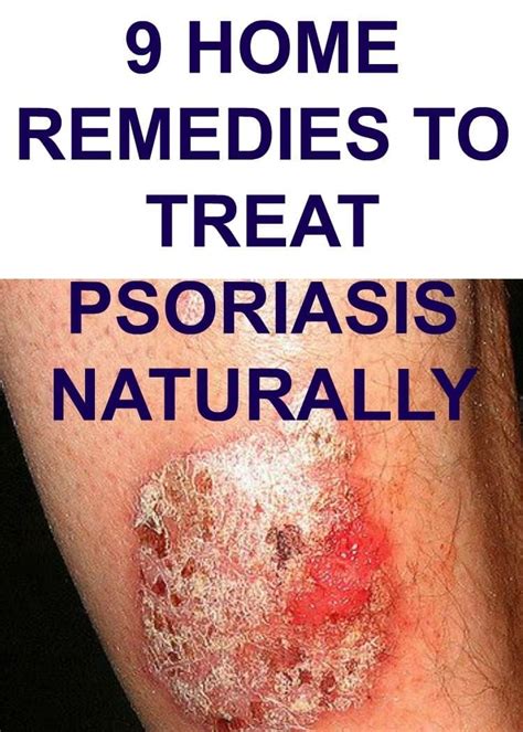 9 HOME REMEDIES TO TREAT PSORIASIS NATURALLY | Treat psoriasis, Plaque ...