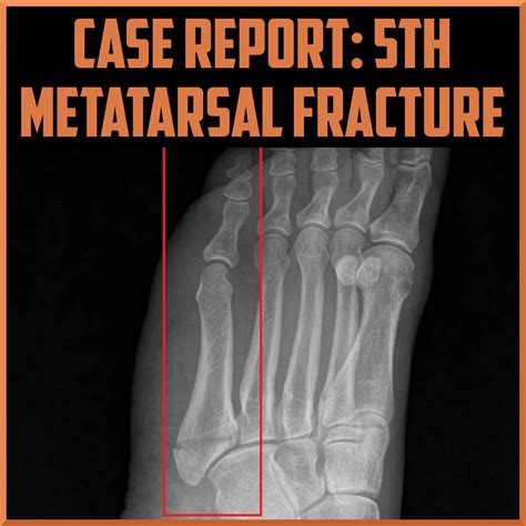 Case Report: fifth Metatarsal Fracture - foppa.casa