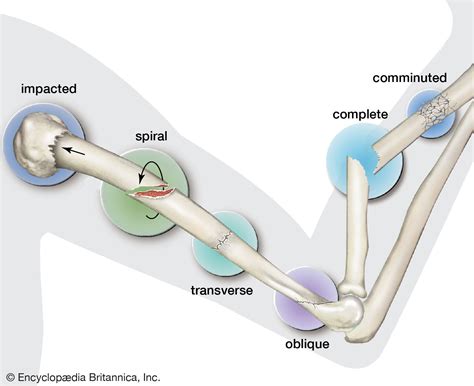 fracture summary | Britannica