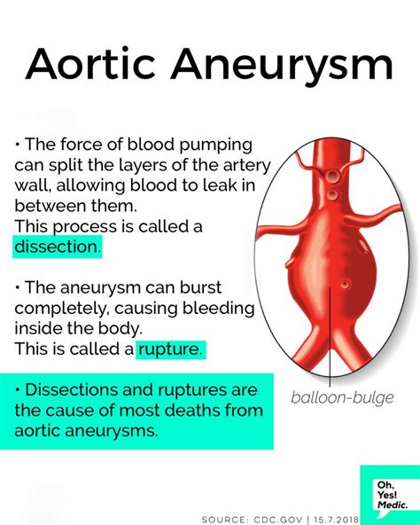 Aortic Aneurysms | Cardiac nursing, Medical knowledge, Nursing school