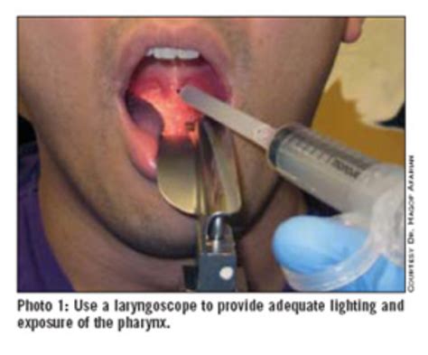 Owning the Peritonsillar Abscess — EM Curious