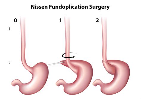 Types Of Hiatal Hernia Surgery