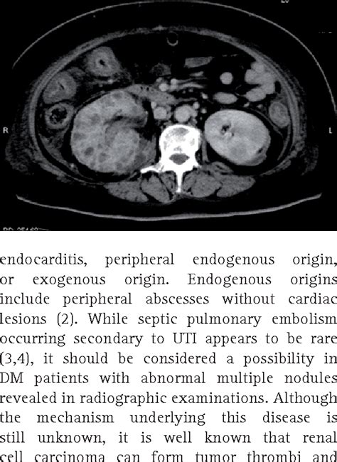 [PDF] A case of septic pulmonary embolism caused by urinary tract ...