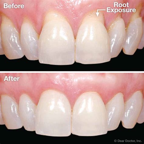 Gingival (Gum) Grafting | Coastal Periodontics & Implant Dentistry, P.C ...