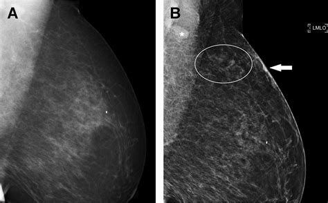 Understanding the Mammography Audit | Radiology Key