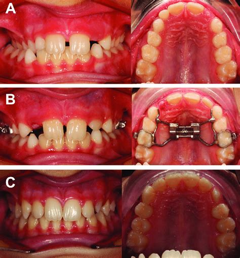 Posterior Crossbite