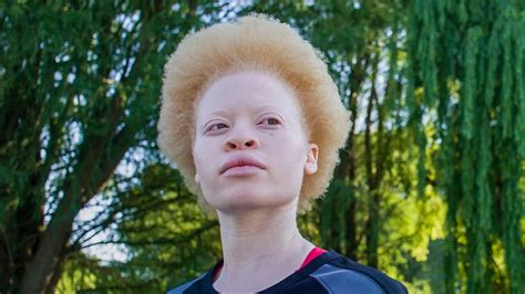 Albino Black People – Telegraph