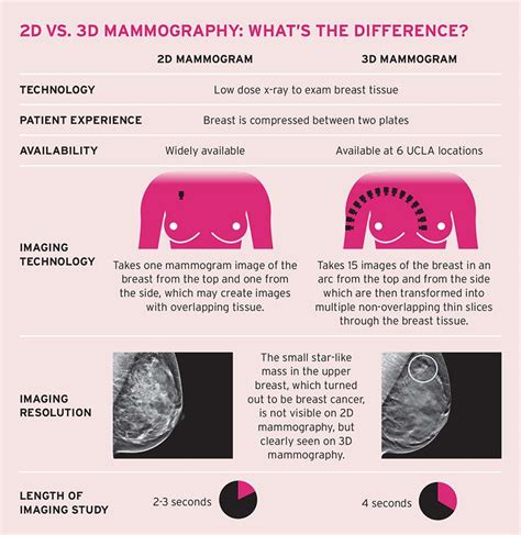 Breast Imaging: 3D Mammography (Tomosynthesis) - Breast Imaging | UCLA ...