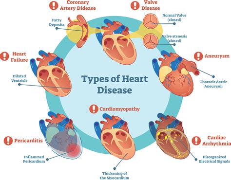 Heart Disease: Diagnosis and Treatment - Pulse Cardiology