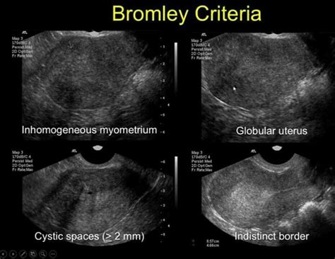 Endometriosis Vs Adenomyosis - What Is Endometritis? Symptoms, Causes ...