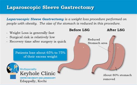 Laparoscopic Sleeve Gastrectomy India - Keyhole Clinic Kochi Kerala