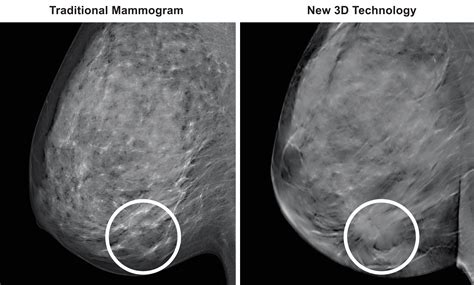 3D Mammography (TM) - Medical Associates of Northwest Arkansas