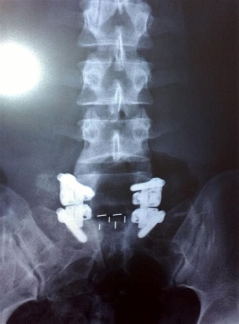 My L5-S1 Spinal Fusion: 1st set of x-rays; second post-op visit w ...