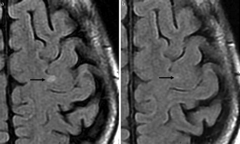 (a) An axial FLAIR image of the first MRI examination obtained from a ...