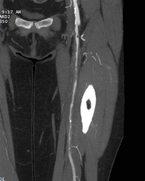 Clinical case: Intermittent claudication - mdct.net