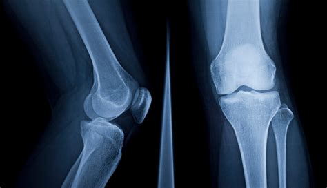 Knee X-Ray: Anatomy, Procedure & What to Expect