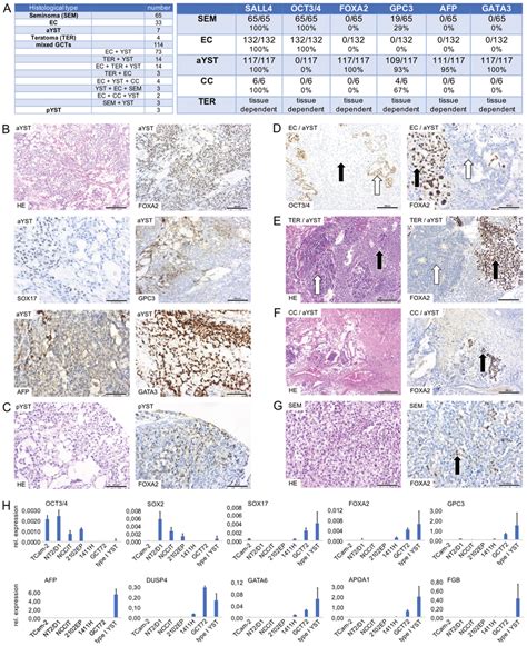 A) Table summarizing numbers of analyzed GCT tissues based on histology ...