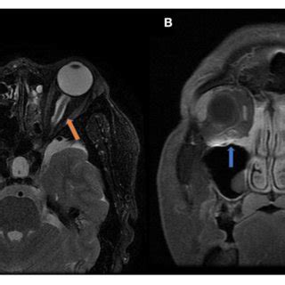 Clinical and radiological features of optic perineuritis. | Download ...