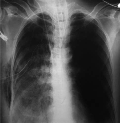 Chest radiograph (antero-posterior view) showing right pneumothorax and ...