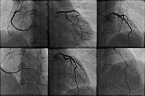 Coronary Angiography Procedure