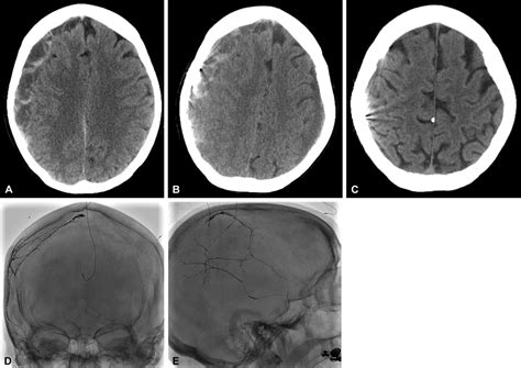 Middle meningeal artery embolization for chronic subdural hematoma: an ...