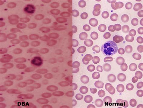 [Figure, Diamond Blackfan anemia. Image courtesy Dr Chaigasame ...