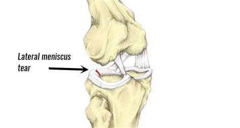 Lateral Meniscus Tear - Symptoms, Causes, Treatment & Rehabilitation