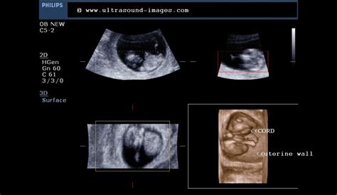 Fetal 3D-ultrasound images at 10 weeks ~ Ultrasound Cases Info