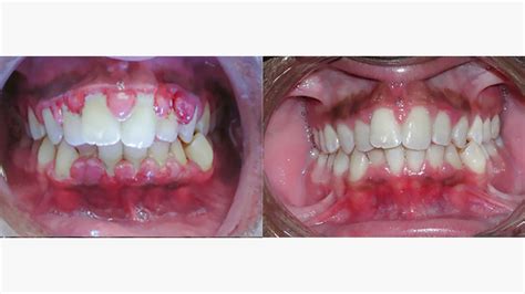 Debridement Dental