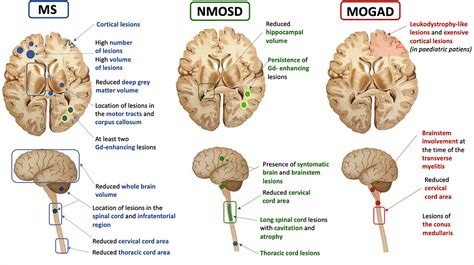 Frontiers | MRI Prognostic Factors in Multiple Sclerosis, Neuromyelitis ...