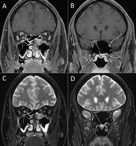 Gd enhancement and T2 lesion of the right optic nerve. Optic nerve MR ...