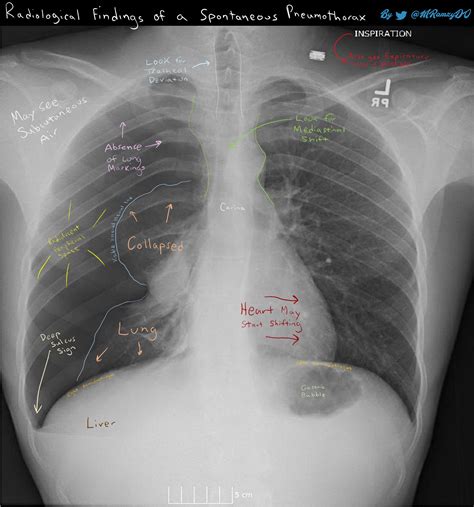 Tension Pneumothorax X Ray Findings