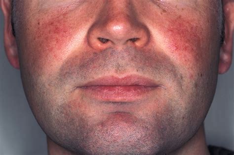 Rosacea - Symptoms - NHS