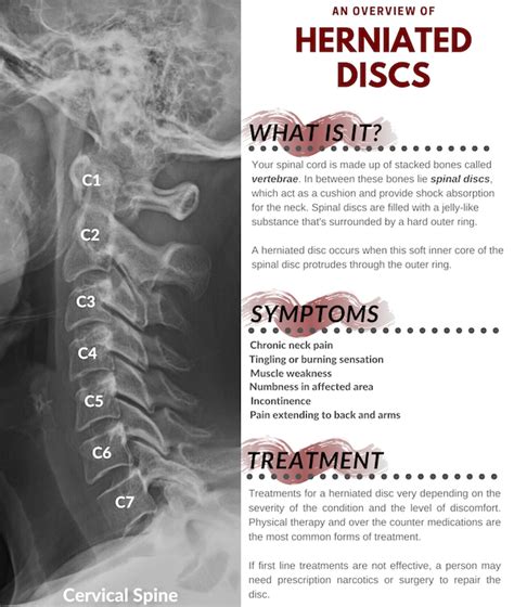 Herniated Disc Settlement Amounts | 2023 Update