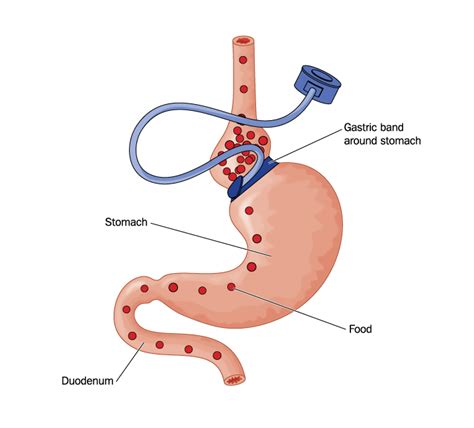 Lap-Band Surgery Recovery: What You Need To Know – Obesity News Today