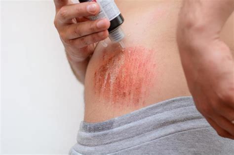 All About Skin Abrasions: Grade and Treatment