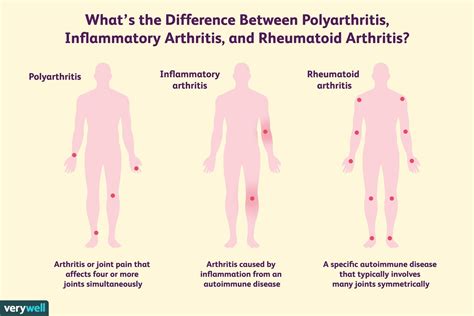 Inflammatory Polyarthropathy, Inflammatory Arthritis, and Rheumatoid ...