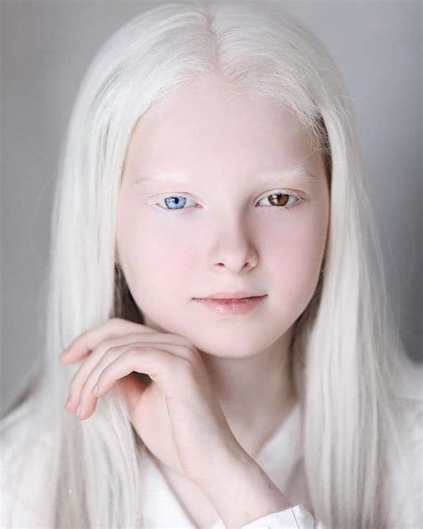 Stunning Portraits of 11-Year-Old Girl With Albinism and Heterochromia